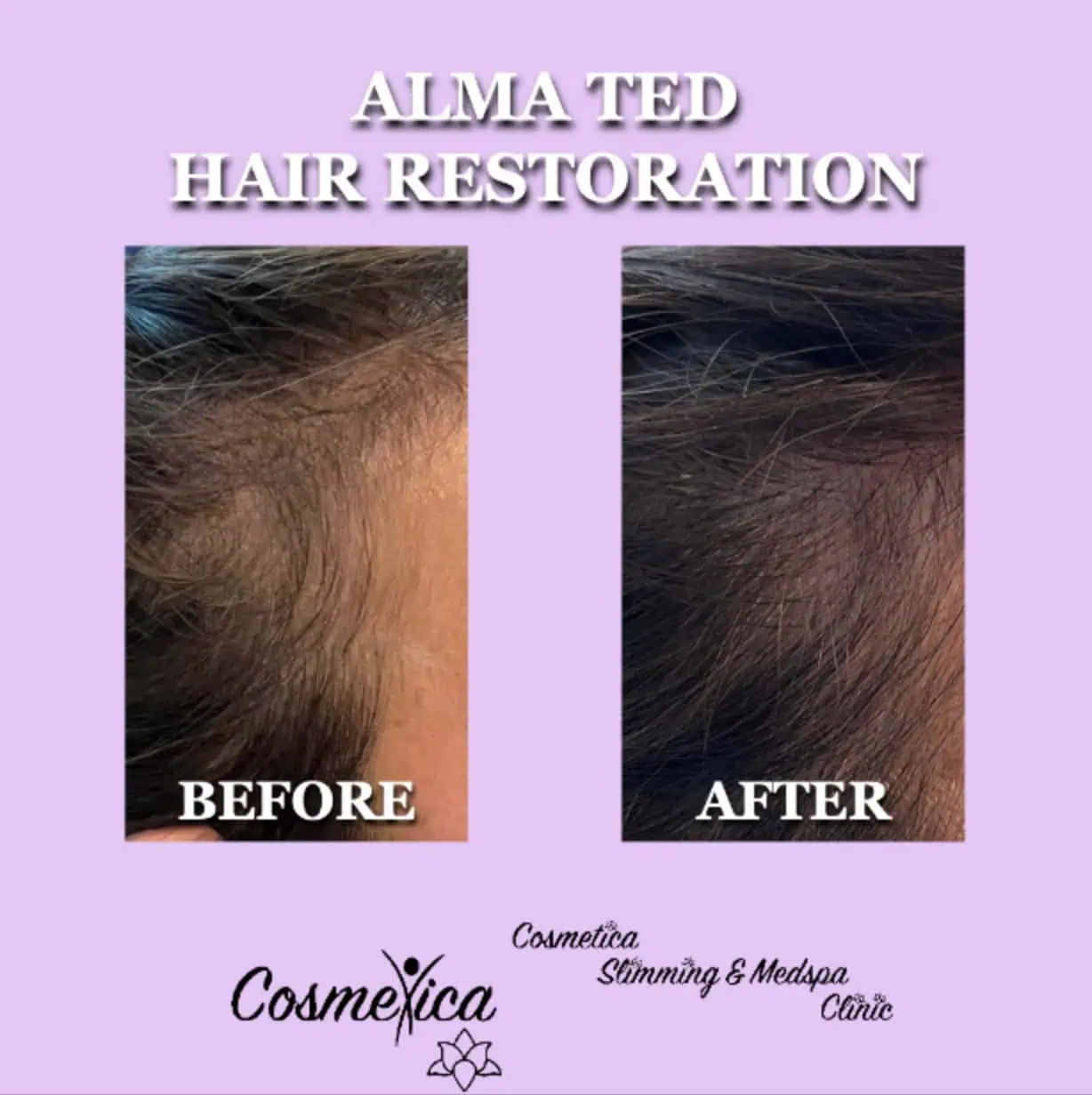 Alma TED Hair Restoration BA ei