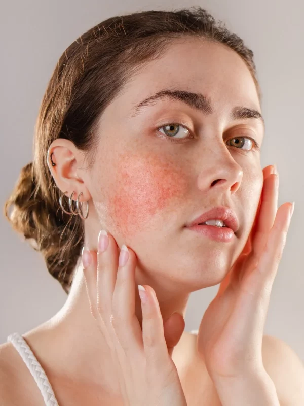 Rosacea in San Mateo CA